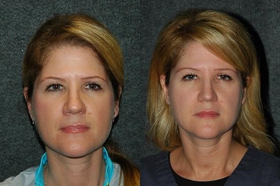 closed vs open rhinoplasty