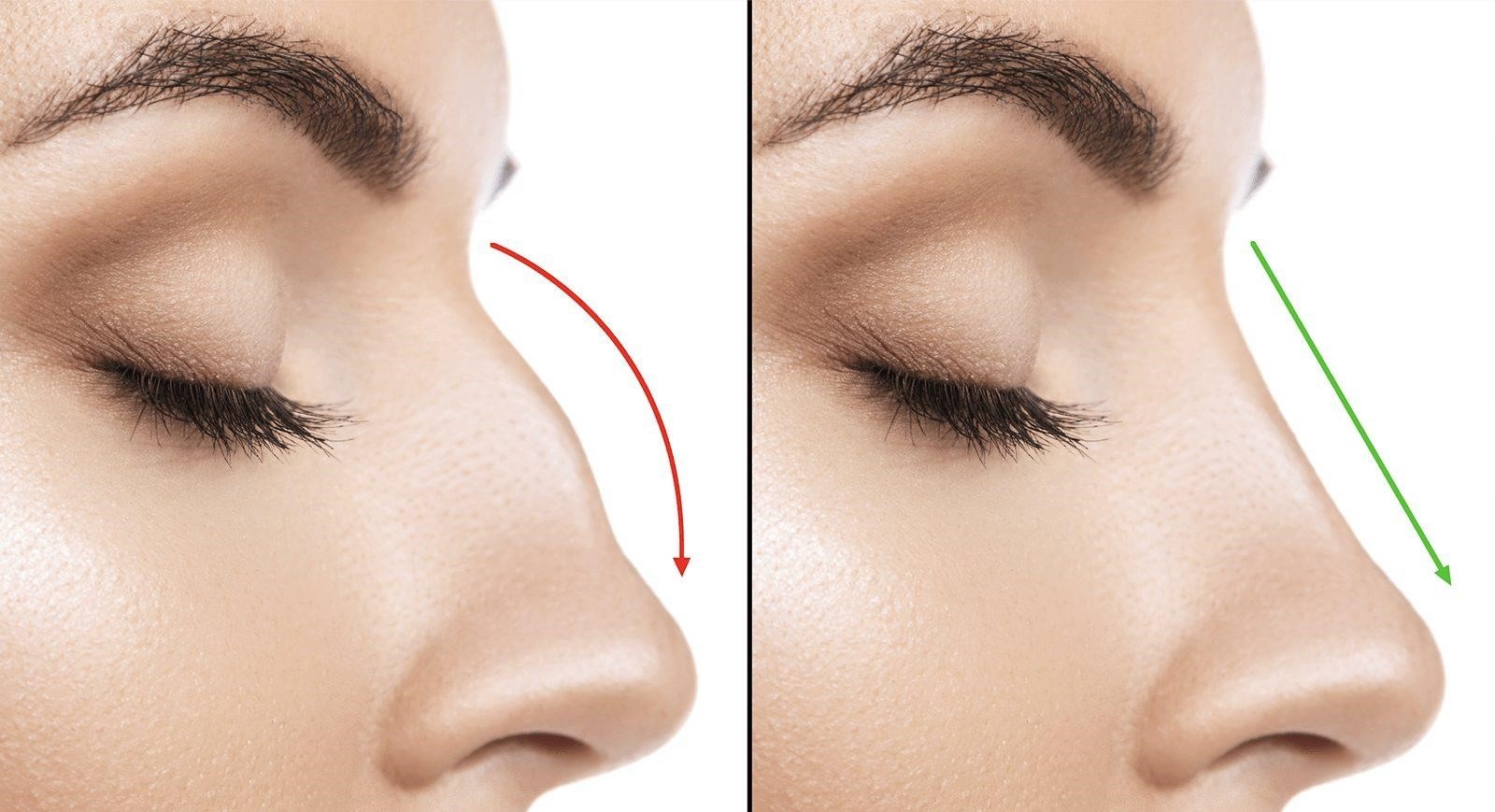 closed vs open rhinoplasty