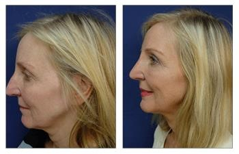 closed vs open rhinoplasty